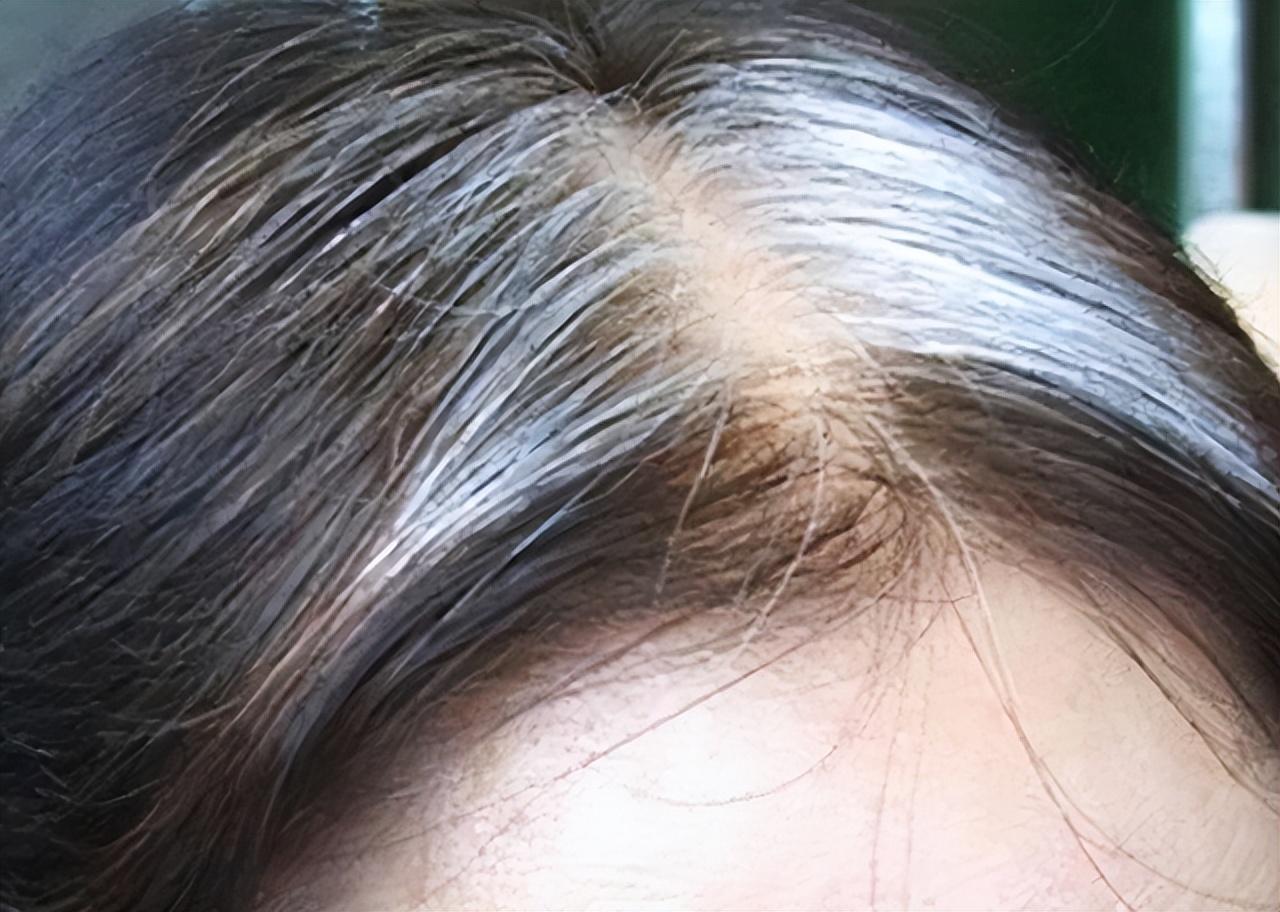 中学生后脑勺长白头发是什么原因造成的(16岁后脑勺长白头发是什么