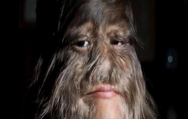 光子脱毛美容(光子美容脱毛价格)