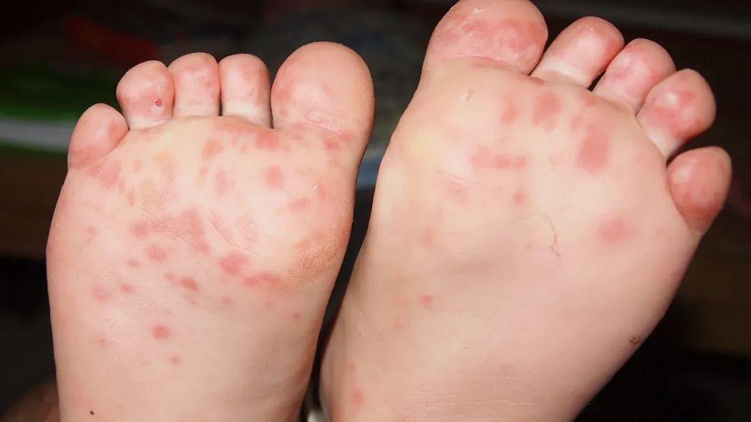 一,炉甘石对这4种情况有效